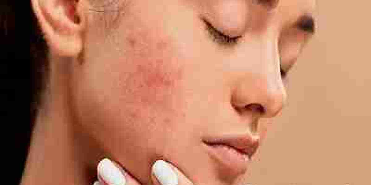 Acne Treatment Market Value, Growth, and Trends
