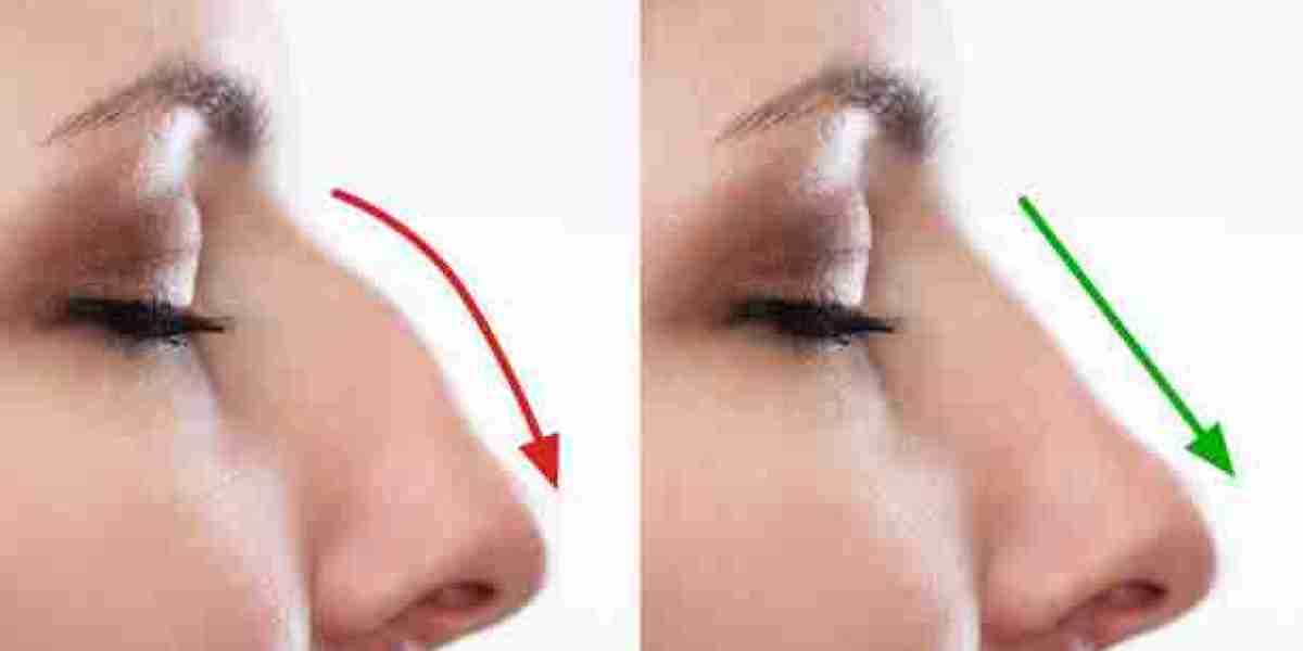 Dubai's Premier Rhinoplasty Specialists: Achieving Your Ideal Nose