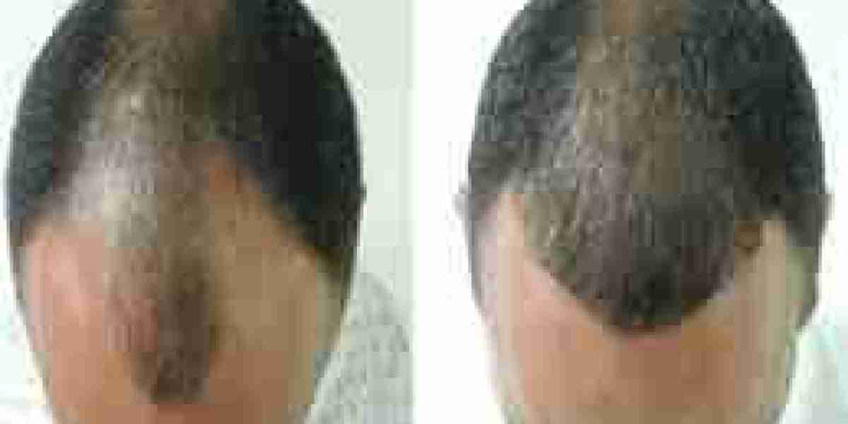 Hair Transplant in Riyadh: Your Comprehensive Guide to Hair Restoration