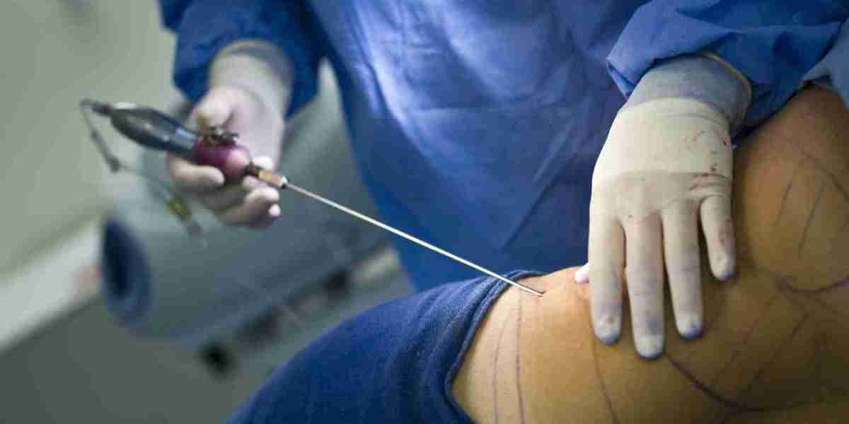 How Much Liposuction Cost in India