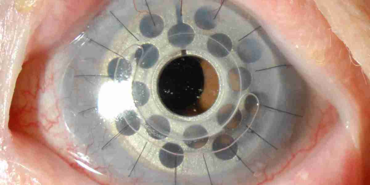 Artificial Cornea and Corneal Implant Market Analysis, Business Development, Size, Share, Trends, Industry Analysis, For