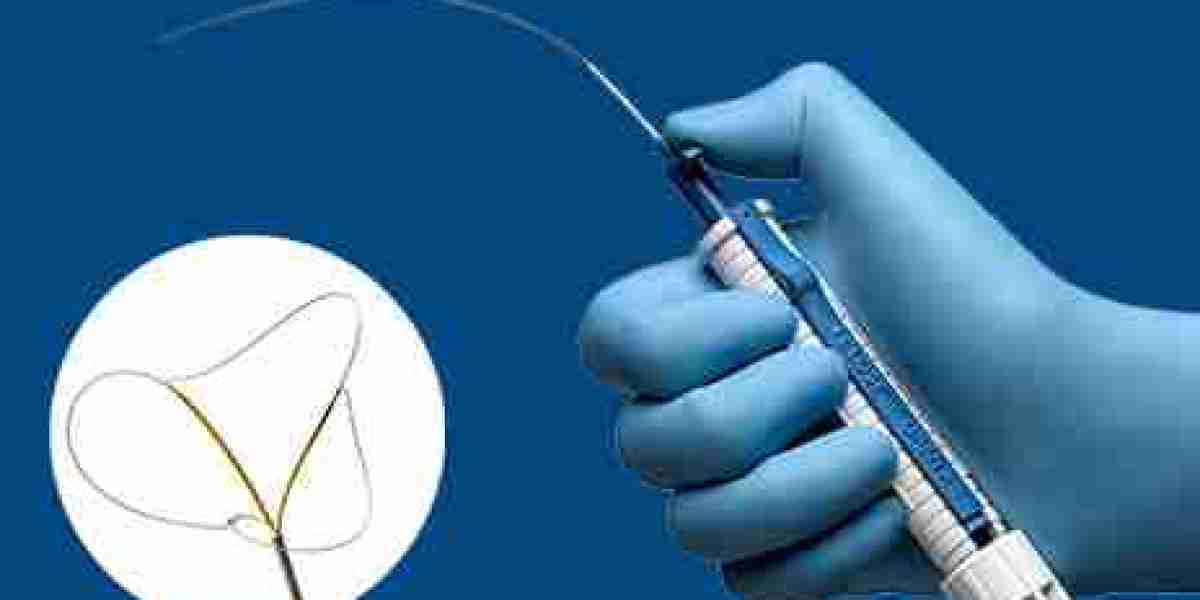Kidney Stone Retrieval Devices Market 2023 Size, Growth Factors & Forecast Report to 2032