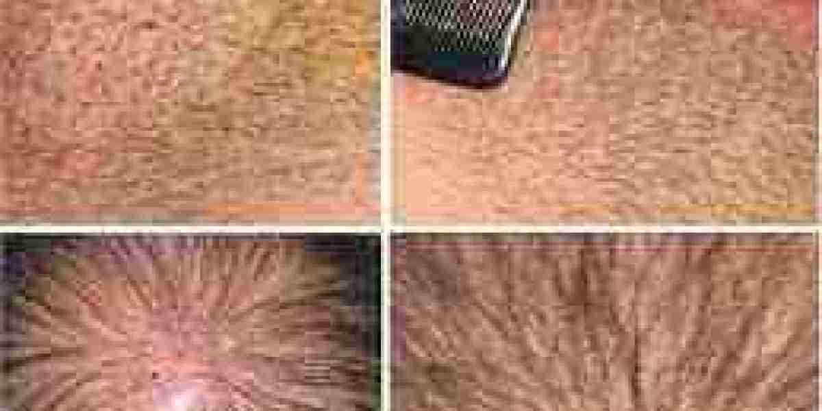 Coping with Alopecia Areata Daily | Hair Transplant