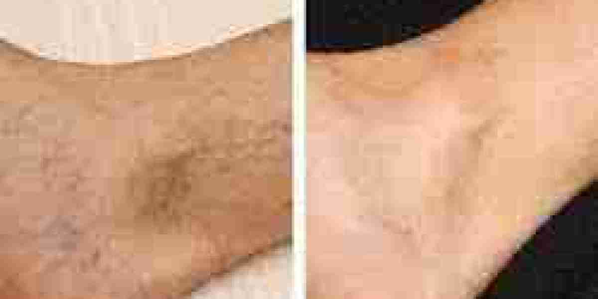 Red Light Therapy Devices for Spider Veins: What You Need to Know