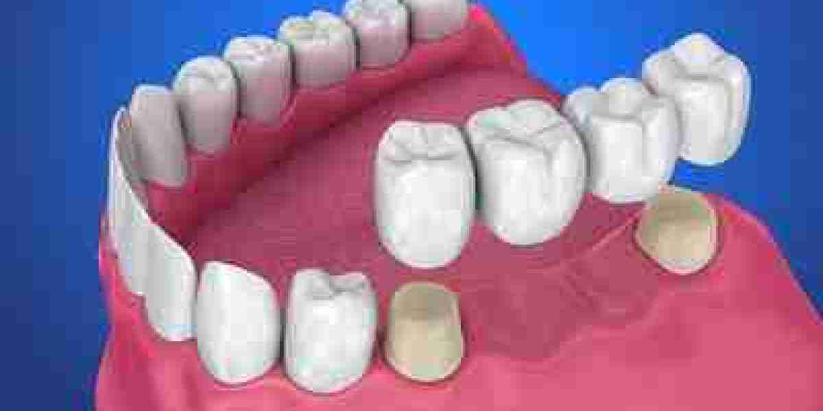 Dental Crowns and Bridges Market to See Massive Growth by 2030