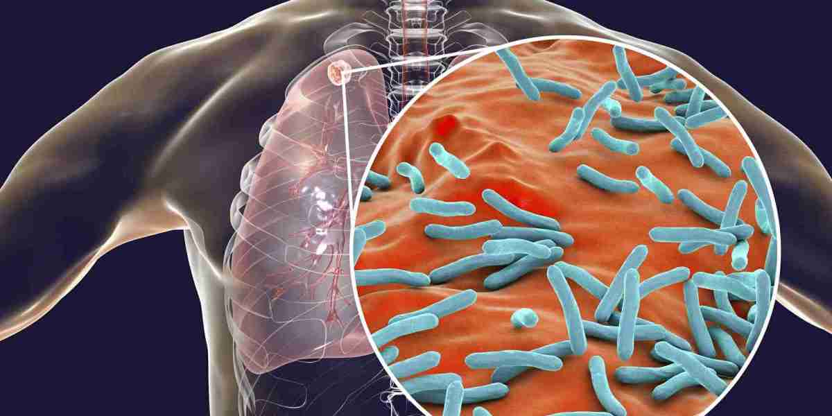 U.S. Tuberculosis (TB) Diagnostics Market Projected to Show Strong Growth