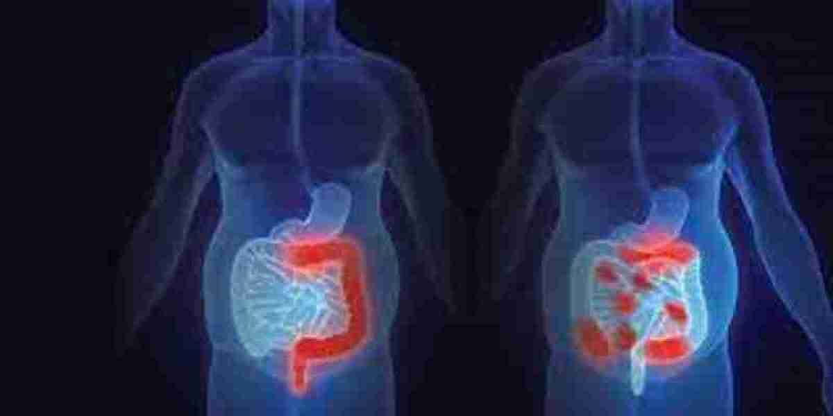 Crohn's Disease Market Analysis, Epidemiology, Trends and Forecast till 2024-2034