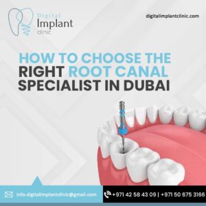 How to Choose the Right Root Canal Specialist in Dubai - Digital Implant