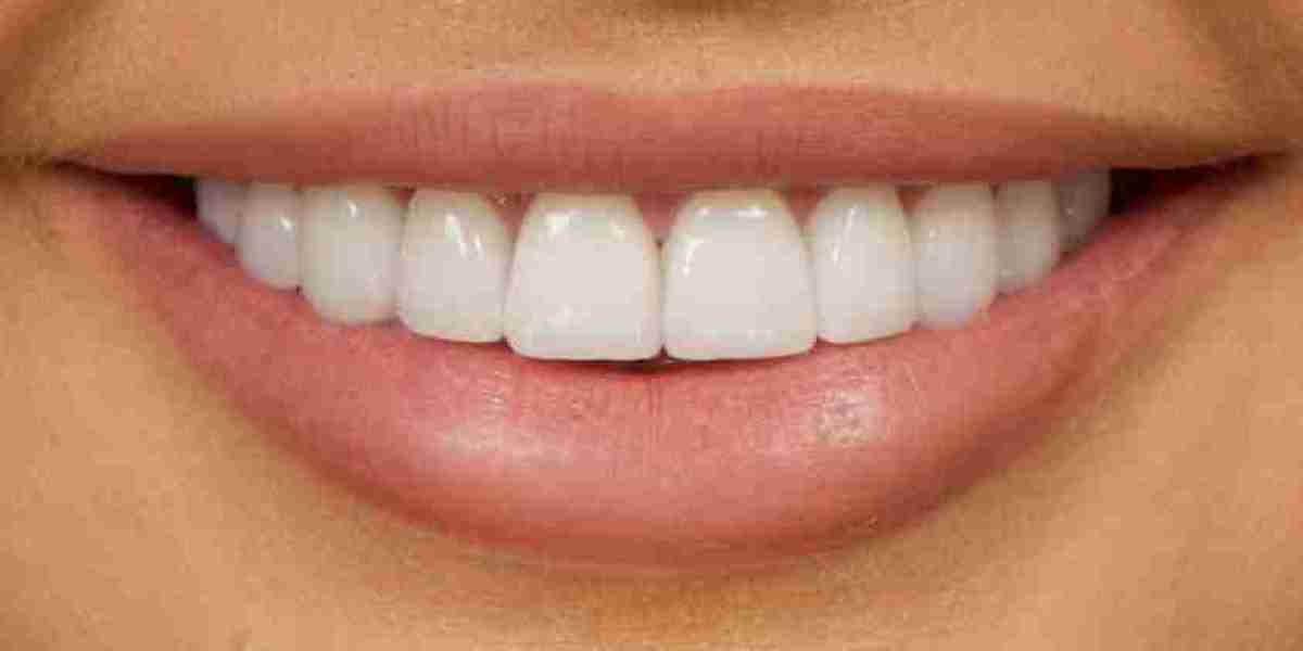 Veneers: Your Pathway to a Radiant Smile
