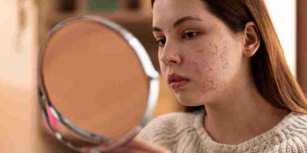 Acne Troubles: How Effective Is Homeopathic Medicine for Clear Skin?