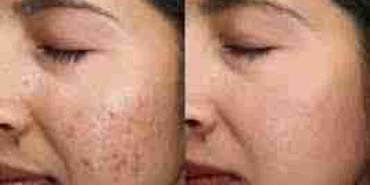 The Science Behind Acne Treatments Available at Clinics