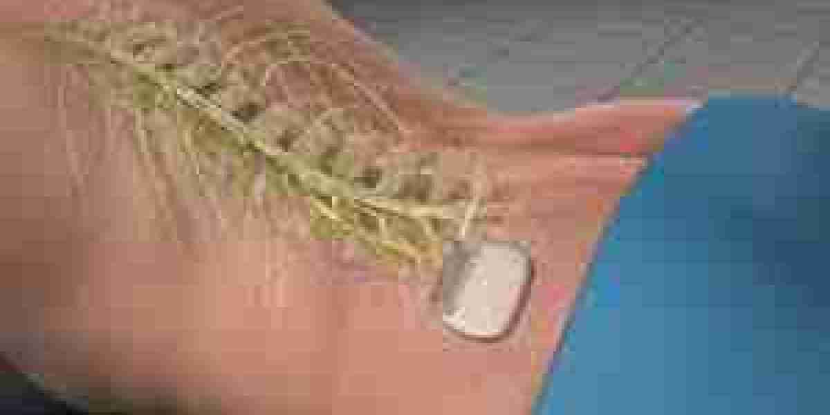 Spinal Cord Stimulation Market To Witness Huge Growth By 2032