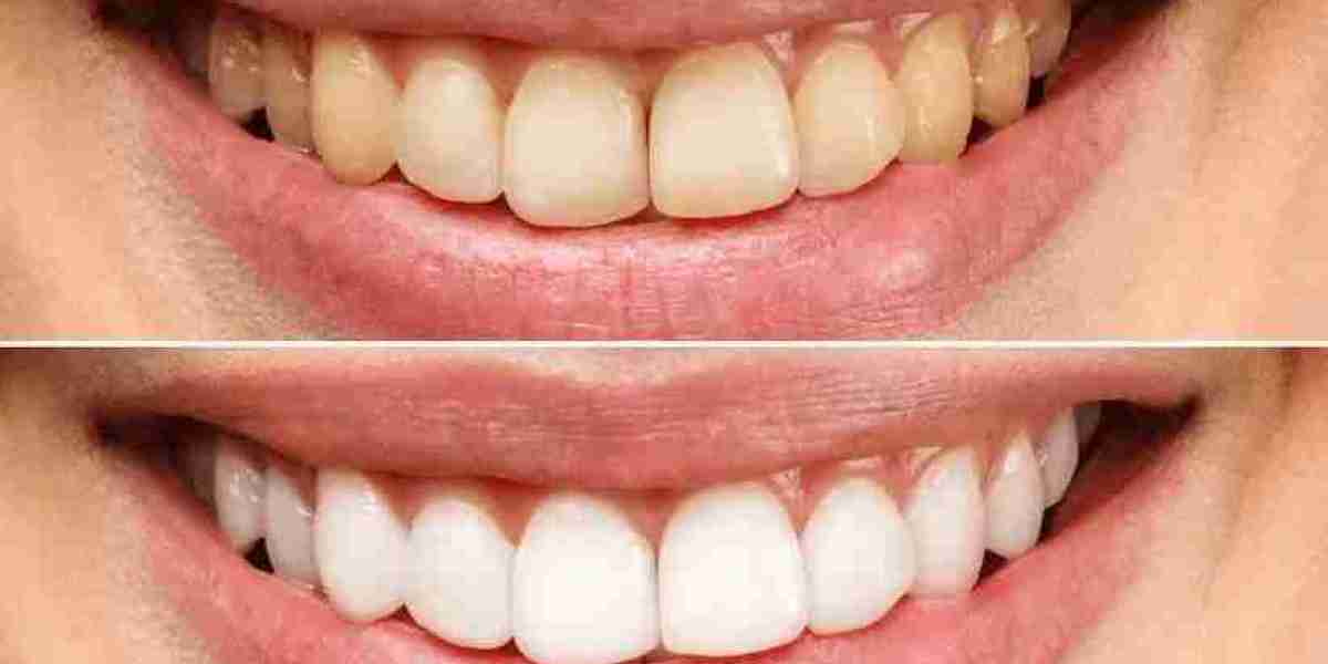 اجعل ابتسامتك مشرقة: أفضل تبييض أسنان في دبي