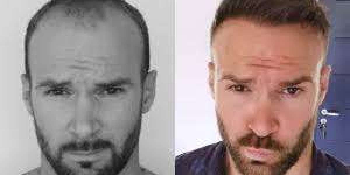 Hair Transplant Turkey: A Global Destination for Hair Restoration