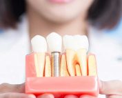Full Mouth Dental Implants Houston | Before and After
