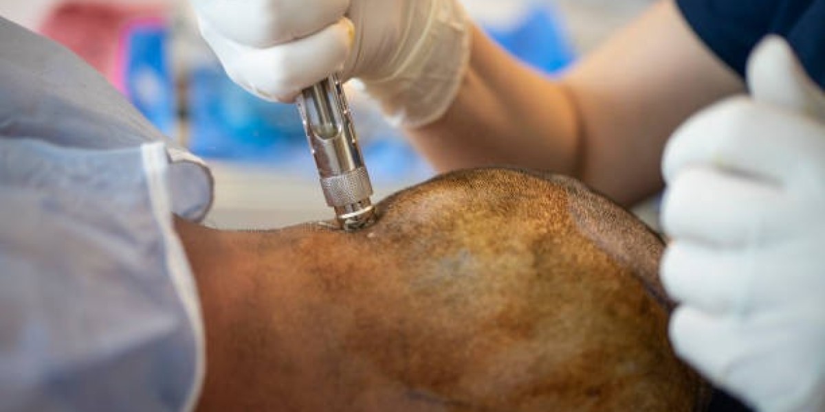 Hair Transplant Cost in Dubai: Your Investment
