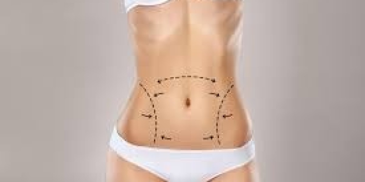 Liposuction vs Weight Loss: What Really Works for Body Shaping