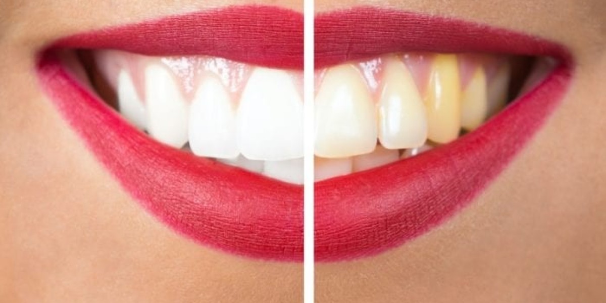 Teeth Whitening: Why Genetics Affects Shade and Brightness