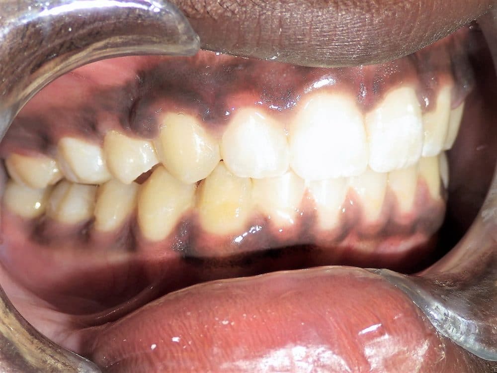 Overbite Before And After Braces | Normal Overbite | Overbite After Braces