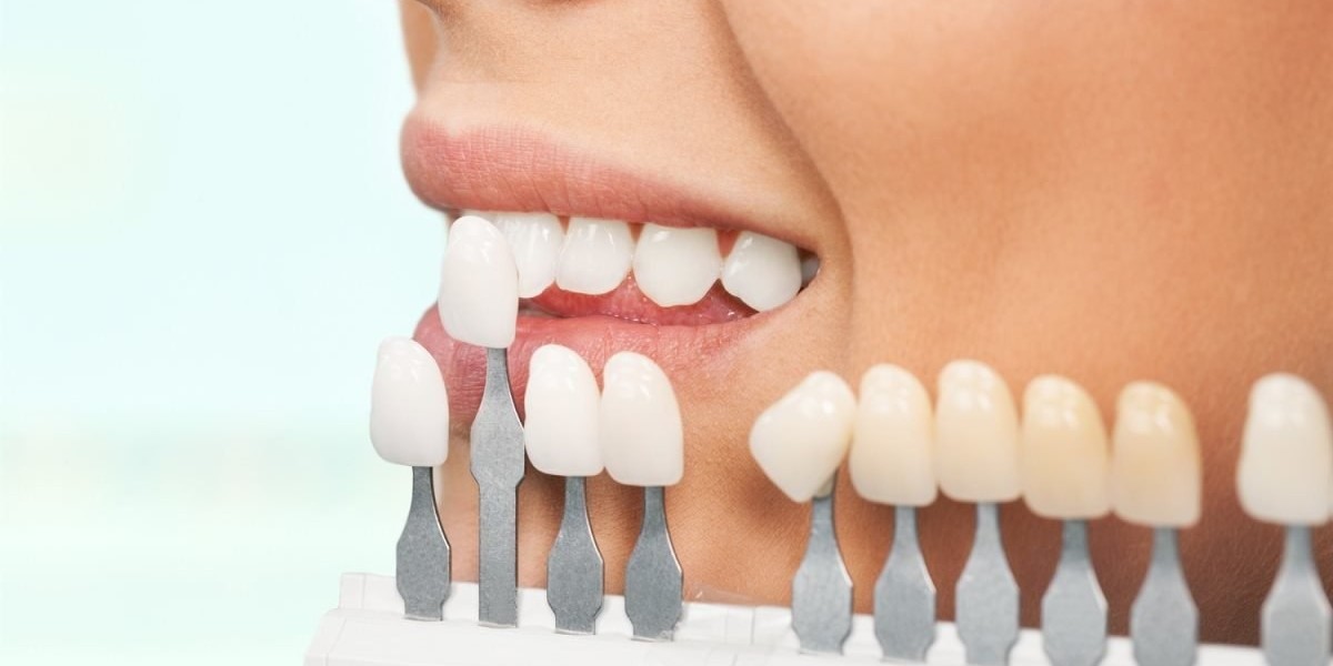 Can Dental Veneers Hide Old Dental Fillings Effectively?